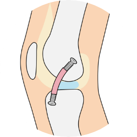 前十字靭帯（ACL）再建術