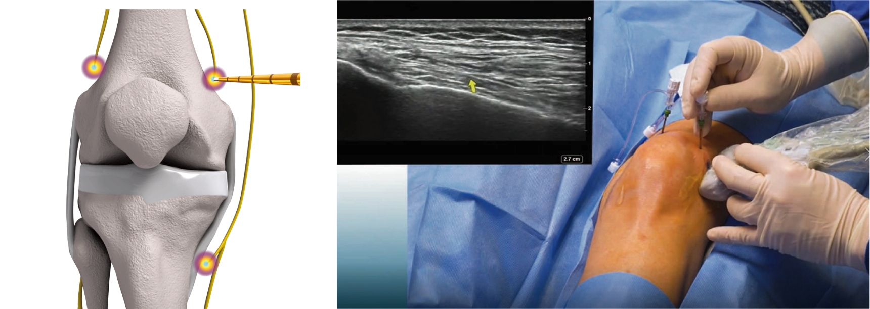 ターゲットとする神経