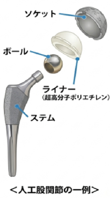 人工股関節のイメージ