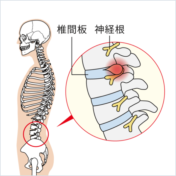 腰椎椎間板ヘルニア