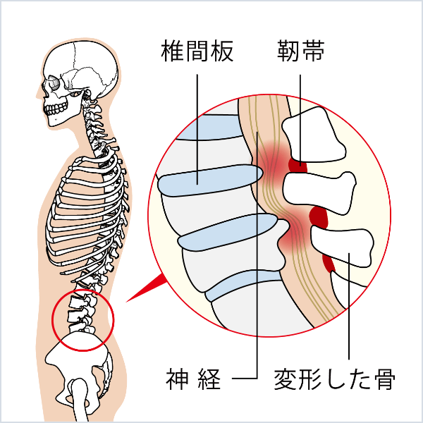 腰部脊柱管狭窄症