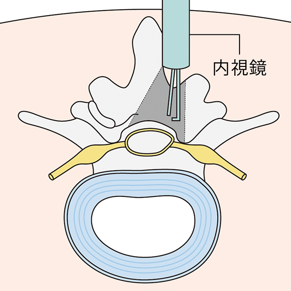 内視鏡下椎弓切除術（MEL）