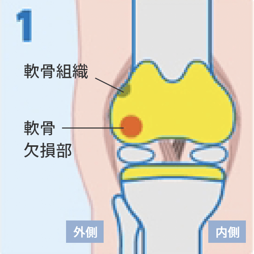 患者さんご自身の軟骨組織を少量採取。（関節鏡での手術）