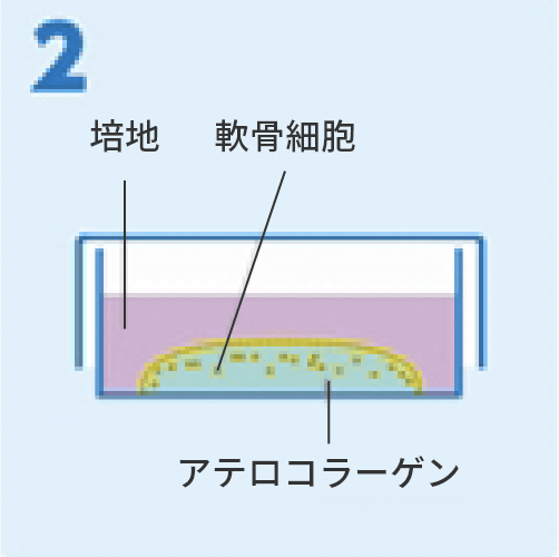 アテロコラーゲン（コラーゲンの一種）と混ぜて培養し、「自家培養軟骨」を作製。。（関節鏡での手術）