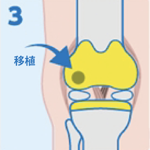 自家培養軟骨を軟骨が欠けたところに移植。