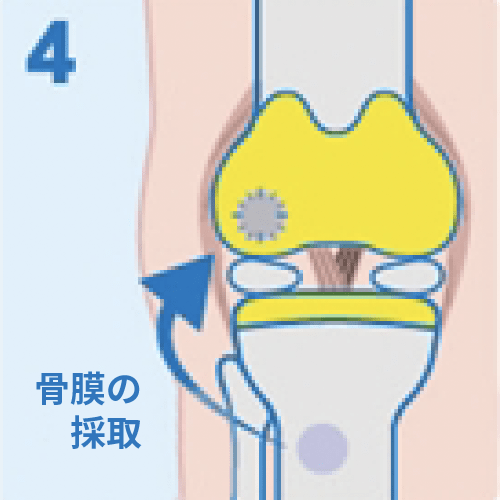 移植した自家培養軟骨が外れないよう脛骨から取った「骨膜」でふたをして縫合。