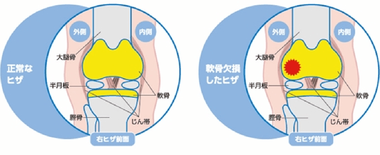 自家培養軟骨移植術とは？