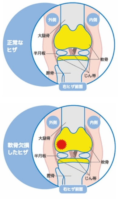 自家培養軟骨移植術とは?
