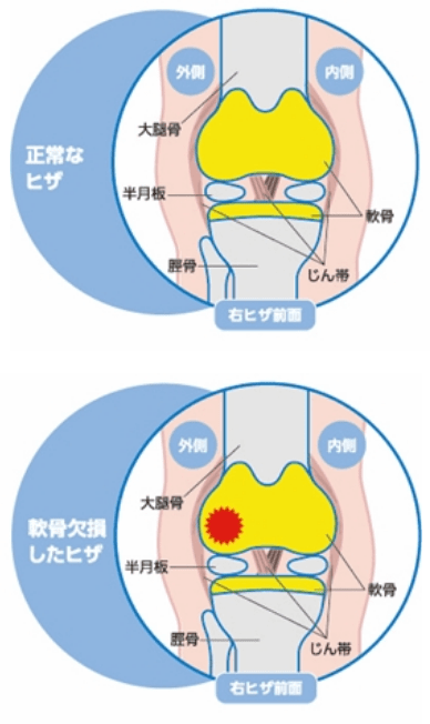 自家培養軟骨移植術とは？