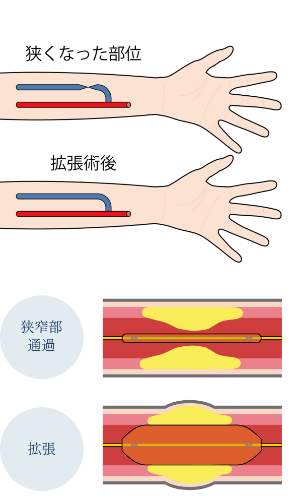 バルーンを膨らませて、血管の狭くなった部分を拡張します。
